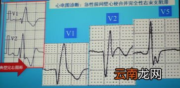 心电图心梗和完全左区别,在心电图上如何区别心肌梗死与高血钾?