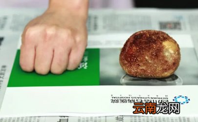 肾结石3mm需要吃药吗