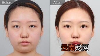 面部吸脂后遗症,面部吸脂的后遗症有哪些？