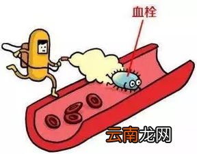 心梗溶栓第十天无力,自从心肌梗死治愈后,为什么会浑身乏力