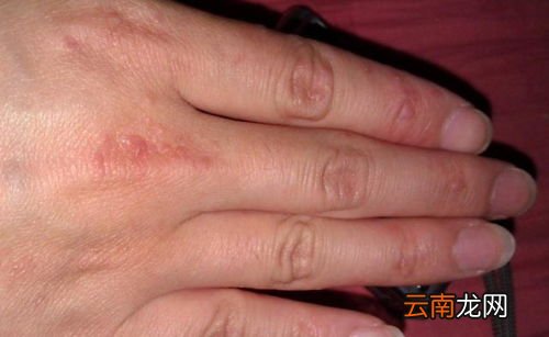 手上长小水泡,手上长小水泡了怎么办？