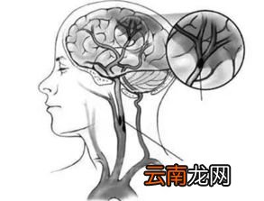 脑梗患者头疼心闷怎么回事,脑梗后为什么会心闷