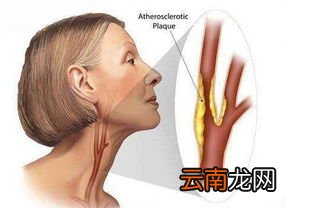 颈动脉斑块拍打多久会引心梗,颈总动脉斑块形成就是冠心病吗