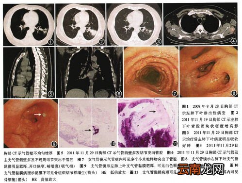 先咳嗽后发烧是肺炎,咳嗽和发热同时出现是肺炎吗。是不是需要到医院做一下检查呢