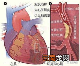 心梗溶栓后可以吃豆腐吗,脑血栓病人吃什么食物好