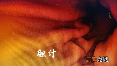 哪种胃病会引起胸闷,胃病会导致胸闷吗?