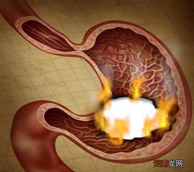 胃病老吃药不好，养生专家：胃病有多种症状，每天养胃1招解决