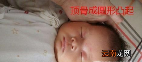 额头有异骨- 面相额头骨头突出