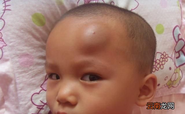 为什么头被撞击容易起包?