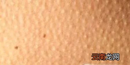 手臂上有小疙瘩 手臂上有鸡皮疙瘩