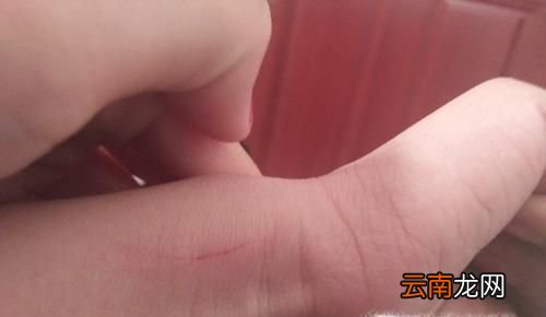 被猫抓伤破皮没出血怎么办