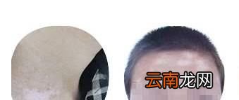 怎么区别它是不是白殿风，白色糠疹用什么药?