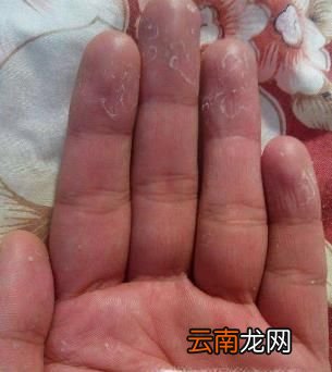 手指脱皮是怎么回事