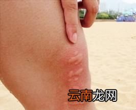 海边游玩被海蜇蜇咬应如何处理