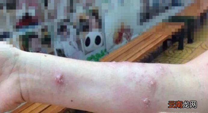 被蚂蚁咬伤 又红又肿又疼又痒怎么办