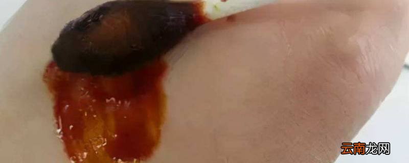 碘酒怎么洗掉