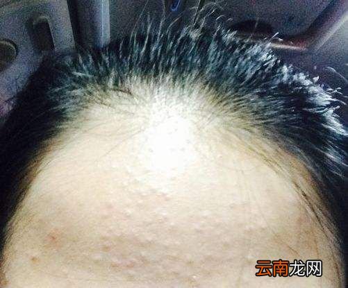 闭口是什么？